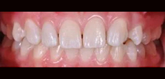 Pediatric Veneers - Featured