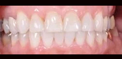 Invisalign - Featured