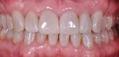 Porcelain Veneers - Featured