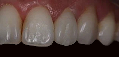 Dental Crowns - Featured