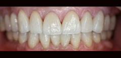 Full Mouth Rehabilitation - Featured
