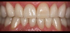 Full Mouth Rehabilitation - Featured