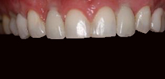 Dental Implants - Featured