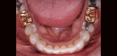Invisalign - Featured