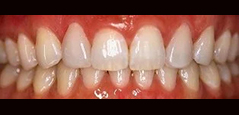 Porcelain Veneers - Featured